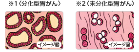 1.分化型胃がん 2.未分化型胃がん