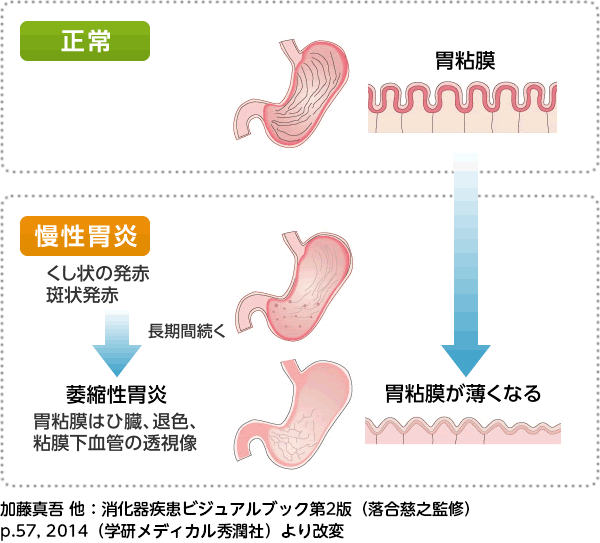 慢性胃炎 | ピロリ菌と病気 | ピロリ菌のお話.jp